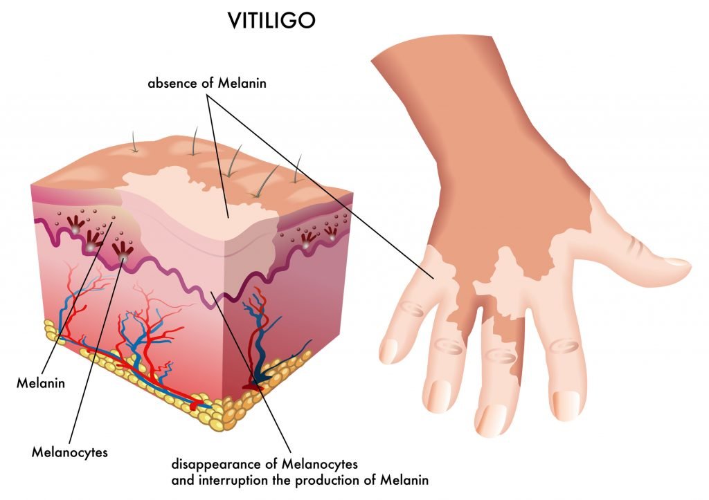 Essential Oils For Vitiligo: When The Natural Skin Pigment Calls It A ...