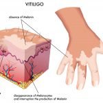 Essential Oils For Vitiligo: When The Natural Skin Pigment Calls It A Day!