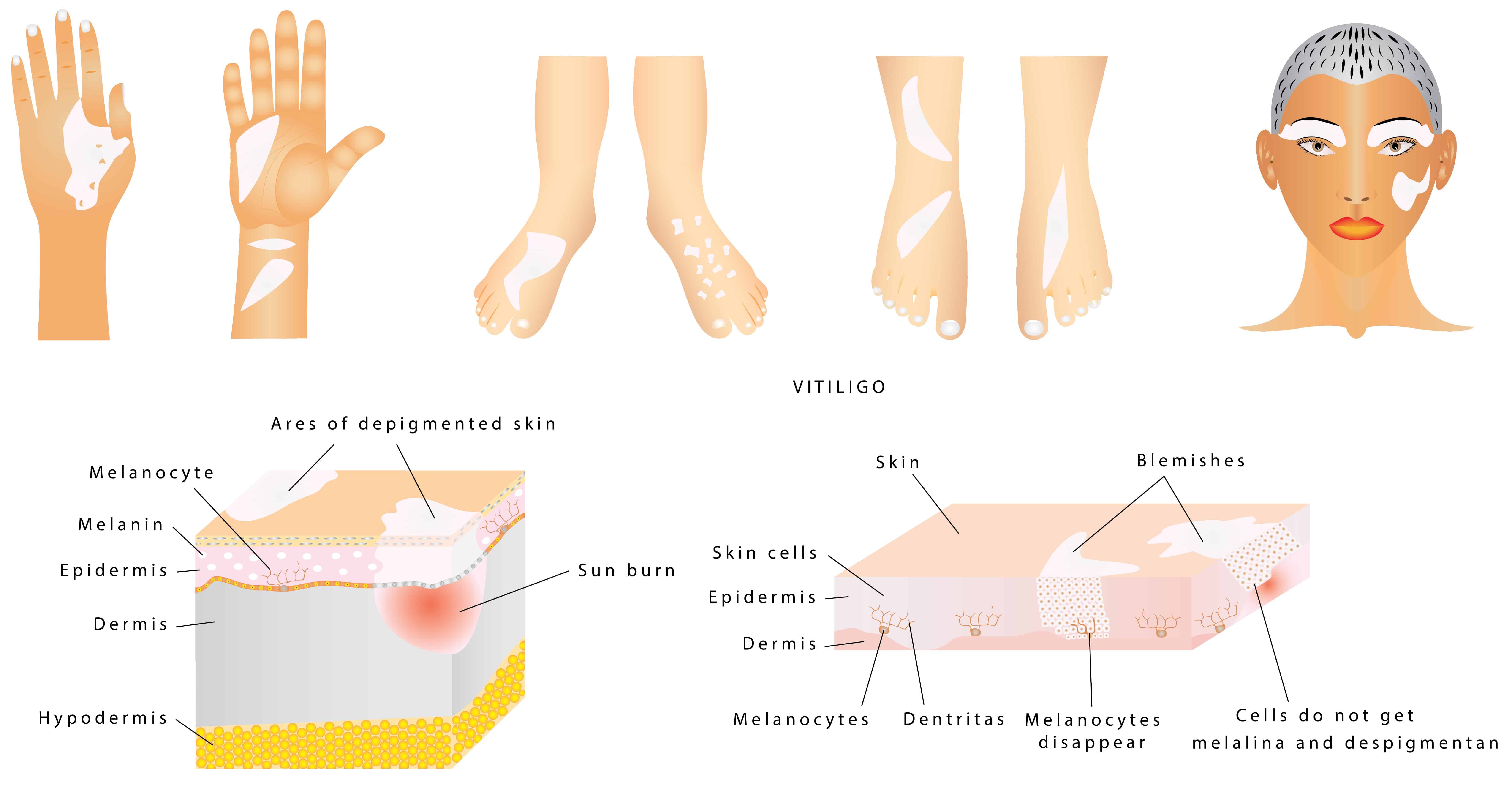 Essential Oils For Vitiligo: When The Natural Skin Pigment Calls It A Day! Essential Oil Benefits