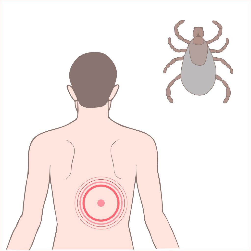 Essential Oils For Lyme Disease: The Tick Bite That Really Sticks With You Essential Oil Benefits