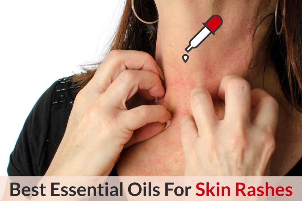 Skin Rashes? Let Essential Oils Handle Those Nasty Eruptions! Essential Oil Benefits