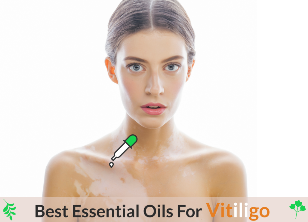 Essential Oils For Vitiligo: When The Natural Skin Pigment Calls It A Day! Essential Oil Benefits