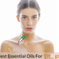 essential oils for vitiligo
