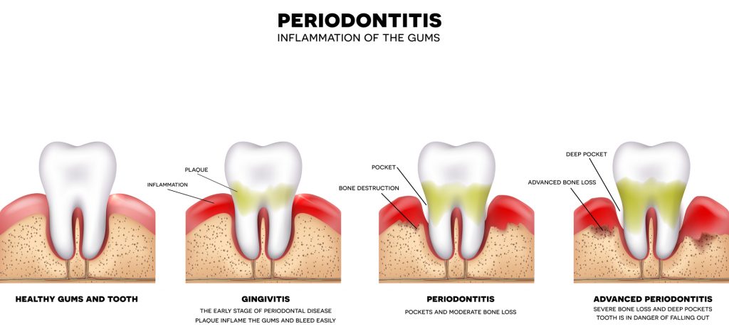 Essential Oil For Receding Gums - Brighten Up Someone’s Day With A Healthy Smile Essential Oil Benefits