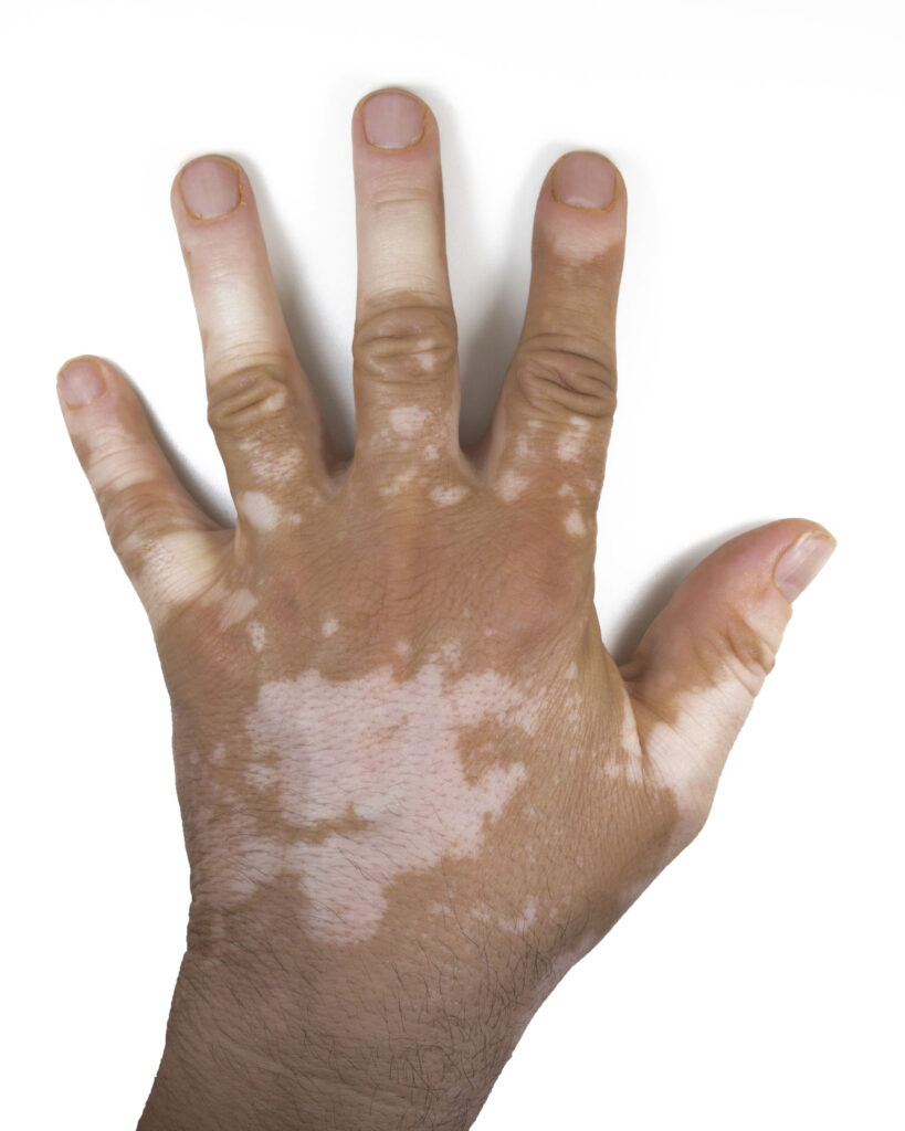 Essential Oils For Vitiligo: When The Natural Skin Pigment Calls It A Day! Essential Oil Benefits