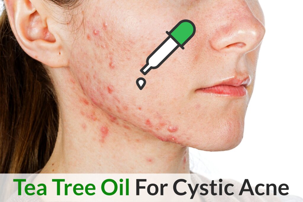 Best Ways To Use Tea Tree Oil For Maximum Relief In Cystic Acne