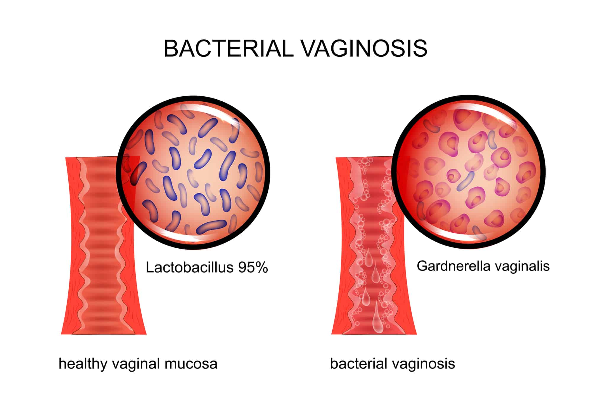 Vaginosis Bakteri Homecare24