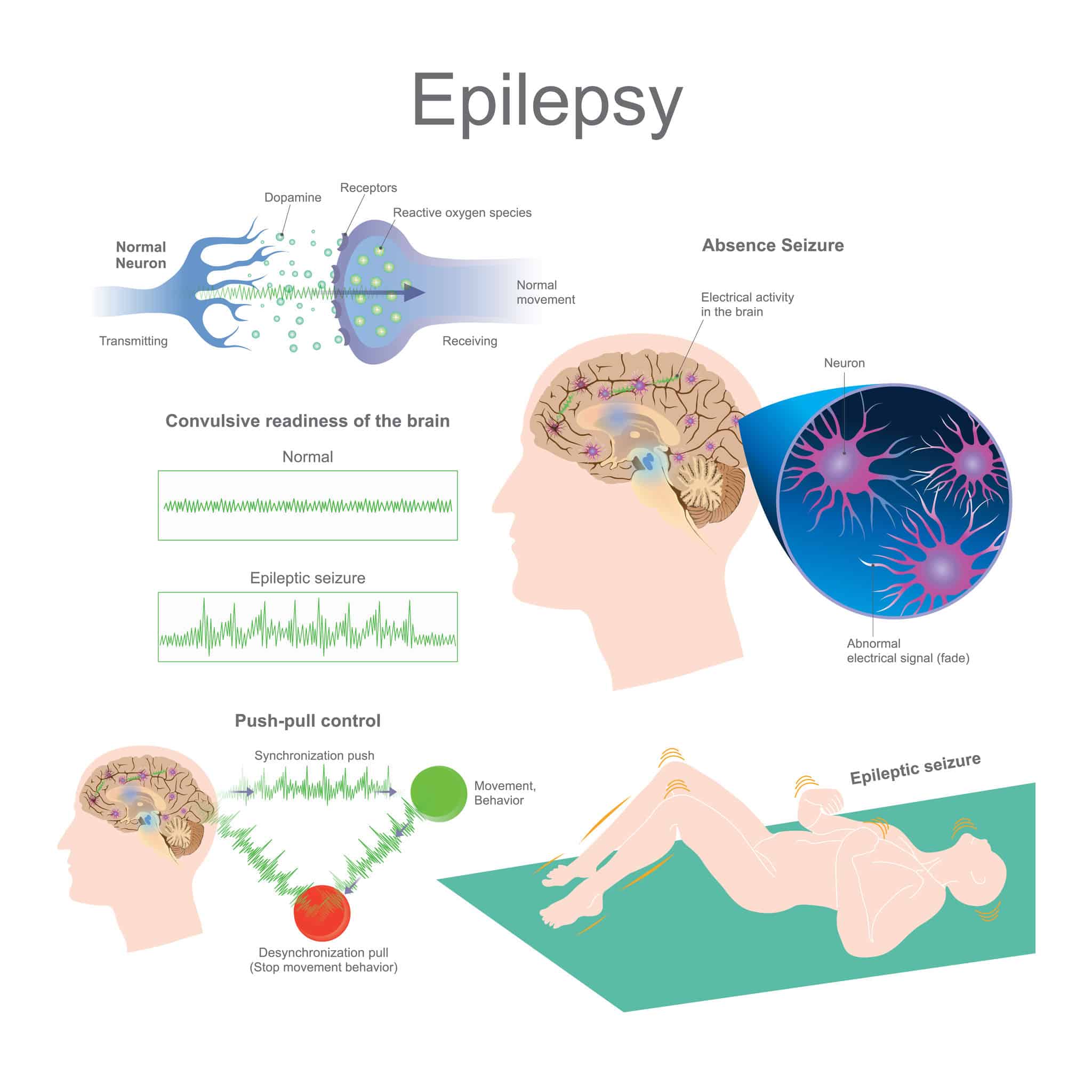 Can epilepsy be transmitted from one person to another?