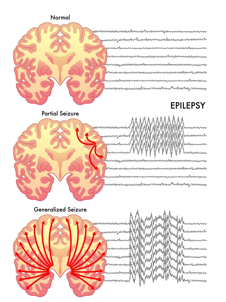 Can Essential Oils Help With Seizures And Epilepsy Essential Oil Benefits