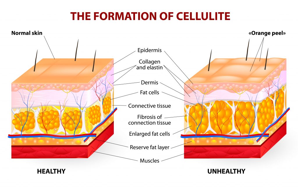 What Are The Best Essential Oils That Treat, Reduce And Remove Cellulite Essential Oil Benefits