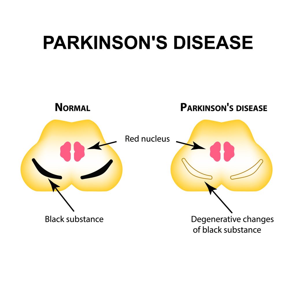 What Are The Best Essential Oils And Recipes To Manage Parkinson's Disease Naturally Essential Oil Benefits