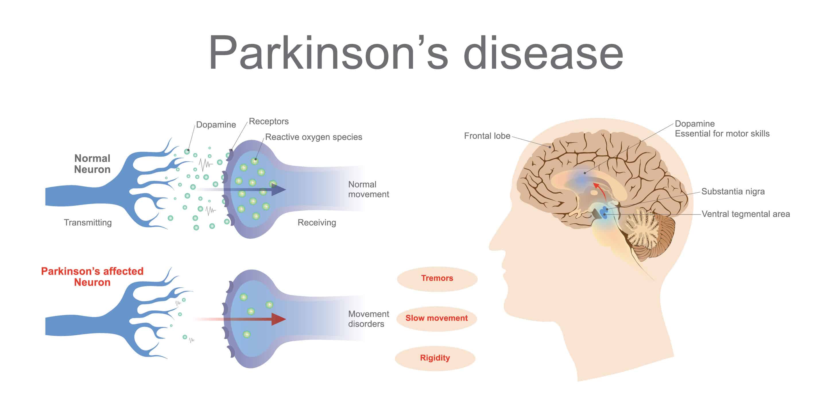 What Are The Best Essential Oils And Recipes To Manage Parkinson's Disease Naturally Essential Oil Benefits