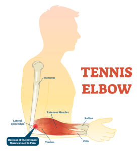 fish oil for tennis elbow