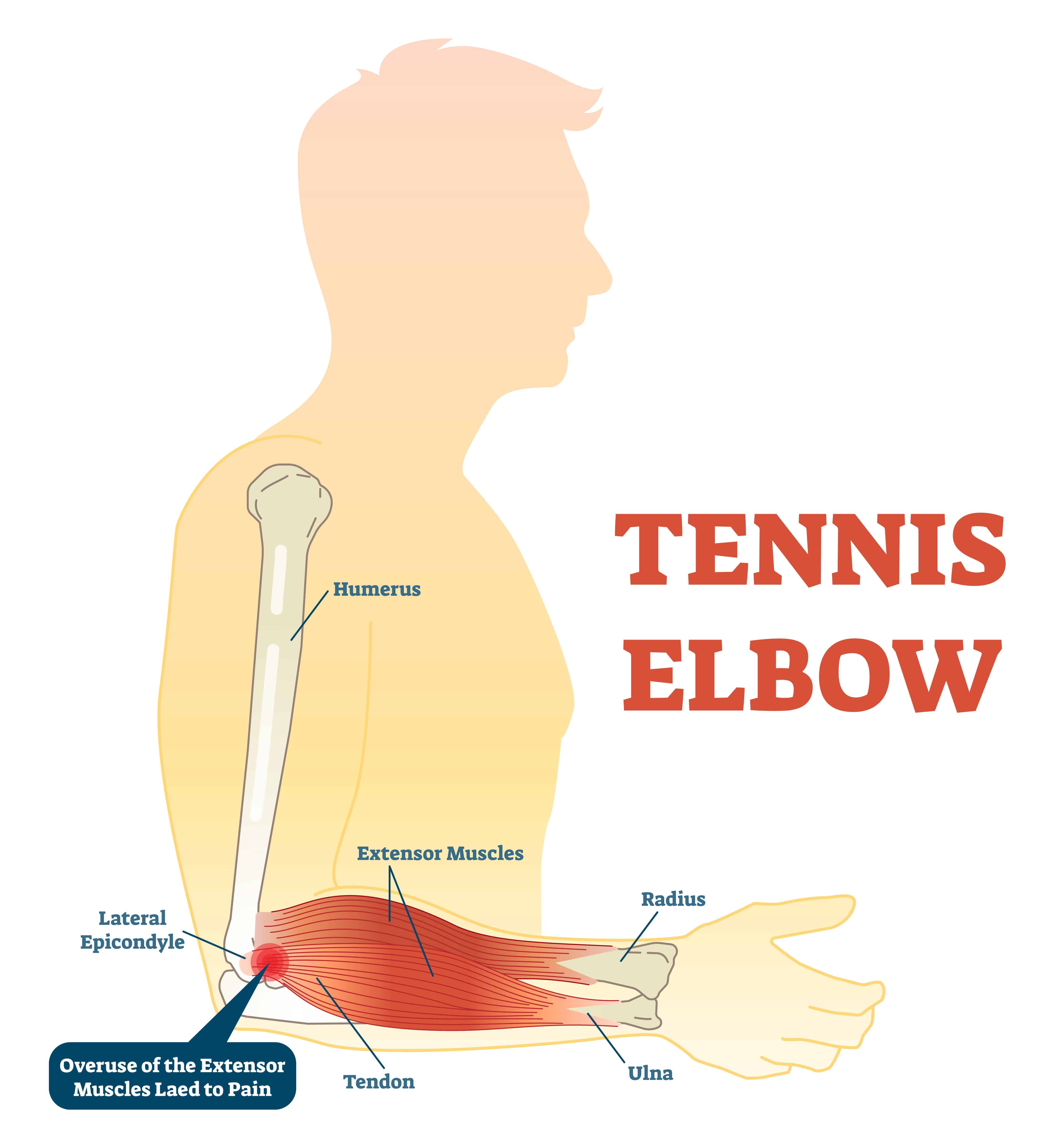 Quelles sont les meilleures huiles essentielles pour Tennis Elbow - Fonctionne aussi pour les non-joueurs de tennis! Avantages des huiles essentielles