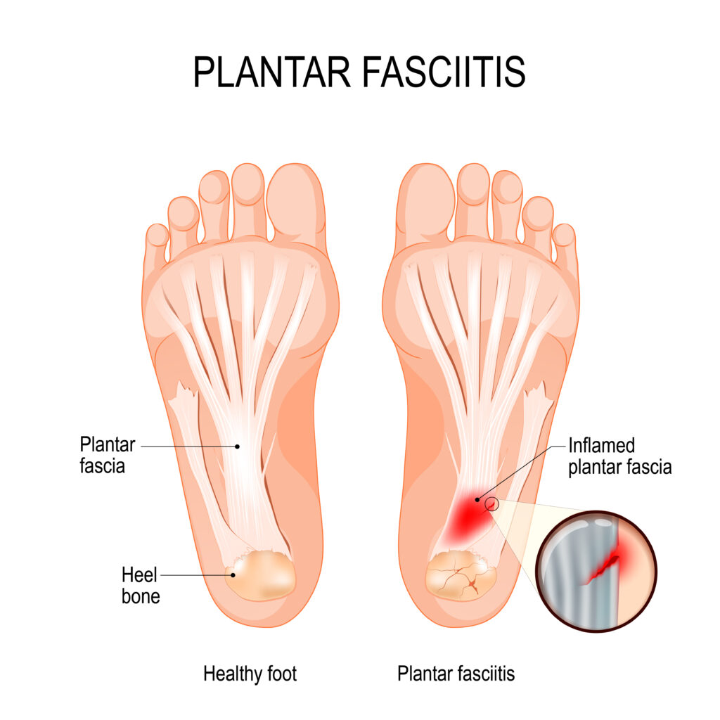 Essential Oils For Plantar Fasciitis: When Your Feet Start Protesting As Soon As You Take Your First Step of the Day! Essential Oil Benefits