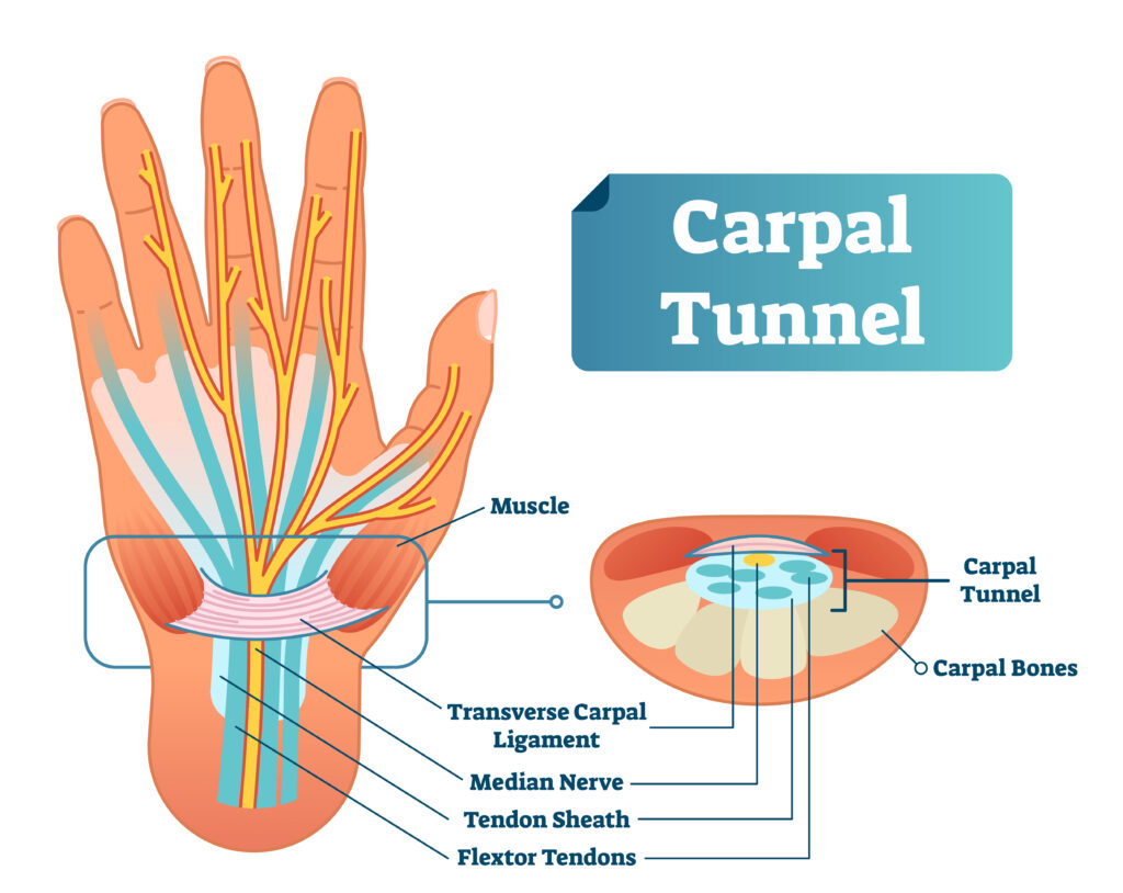 Huiles essentielles pour le syndrome du canal carpien: existe-t-il de meilleures façons de traiter le canal carpien autres que les stéroïdes et la chirurgie? Avantages des huiles essentielles