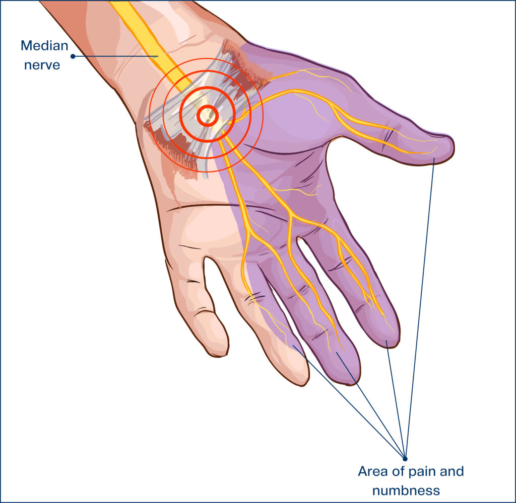 Huiles essentielles pour le syndrome du canal carpien: existe-t-il de meilleures façons de traiter le canal carpien autres que les stéroïdes et la chirurgie? Avantages des huiles essentielles