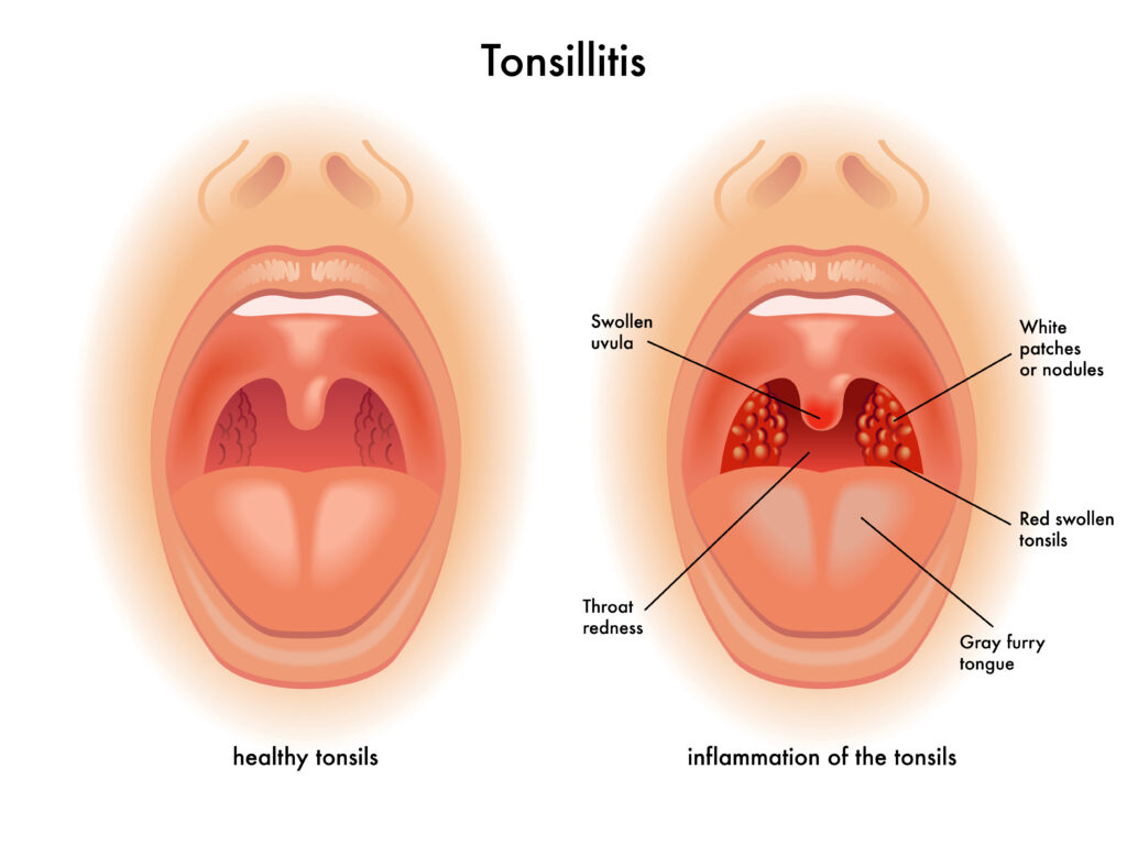 What Are The Best Essential Oils For Tonsillitis Essential Oil Benefits