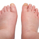 essential oils for swollen feet
