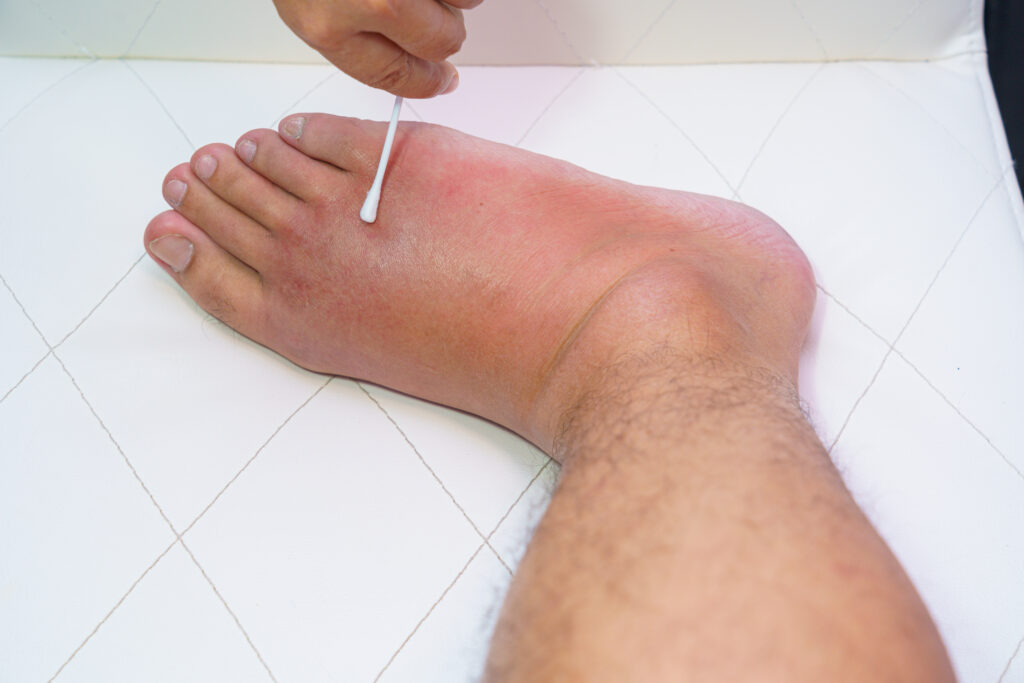 Santé des pieds : Conseils pour traiter le pied enflé - PiedRéseau