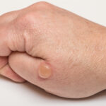 essential oils for blisters