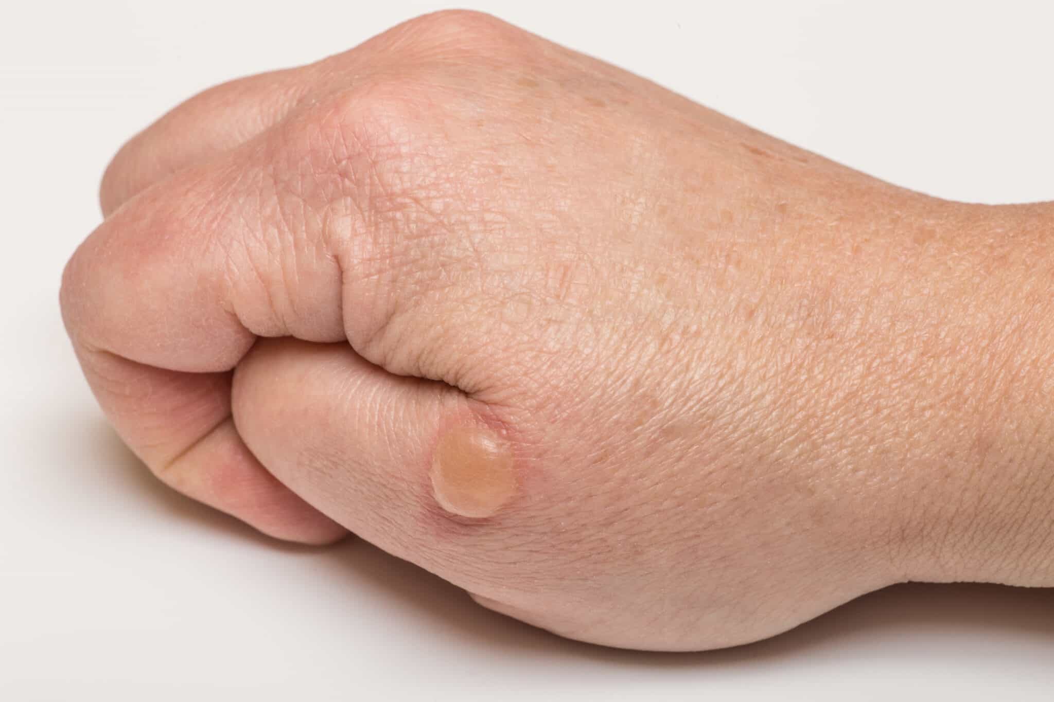 essential oils for blisters