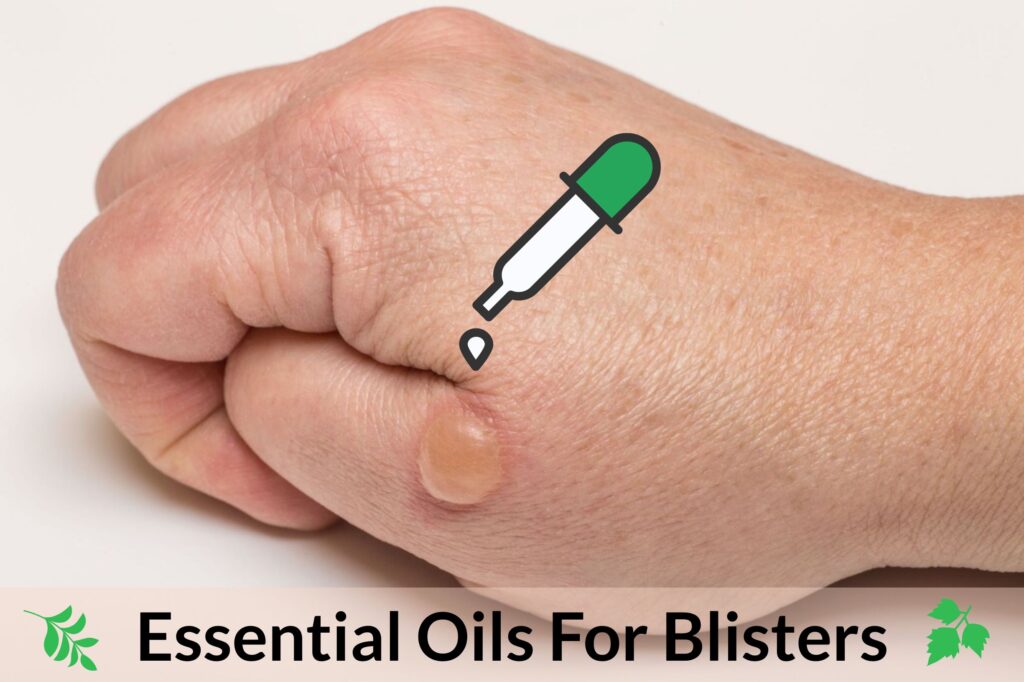 Don’t Let Blisters Stop You From Having Fun Or Working Hard! Let Essential Oils Deal With Them! Essential Oil Benefits