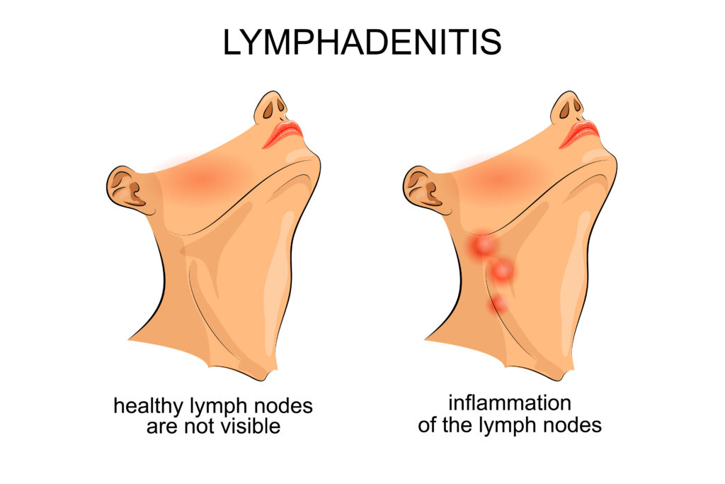 Essential Oils For Lymph Nodes – Time To Deflate Those Painful Mini-Beans Essential Oil Benefits