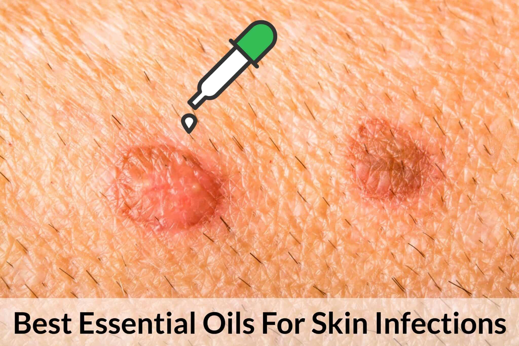 best essential oils for skin infections