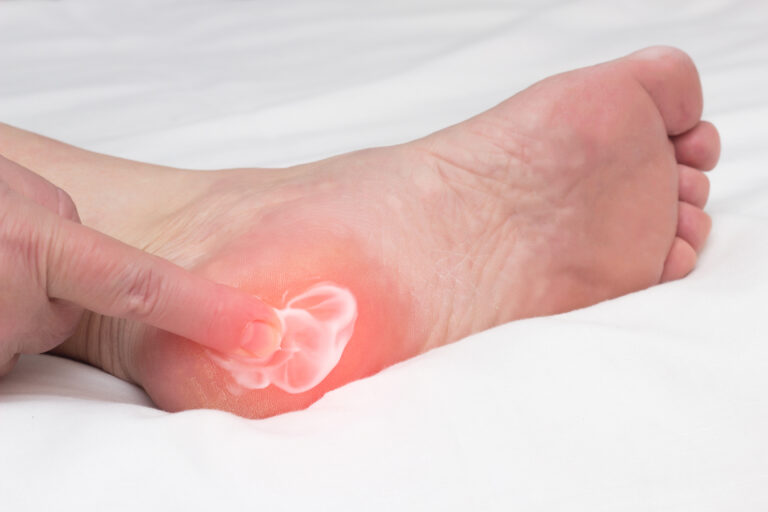 Essential oils for bone spurs