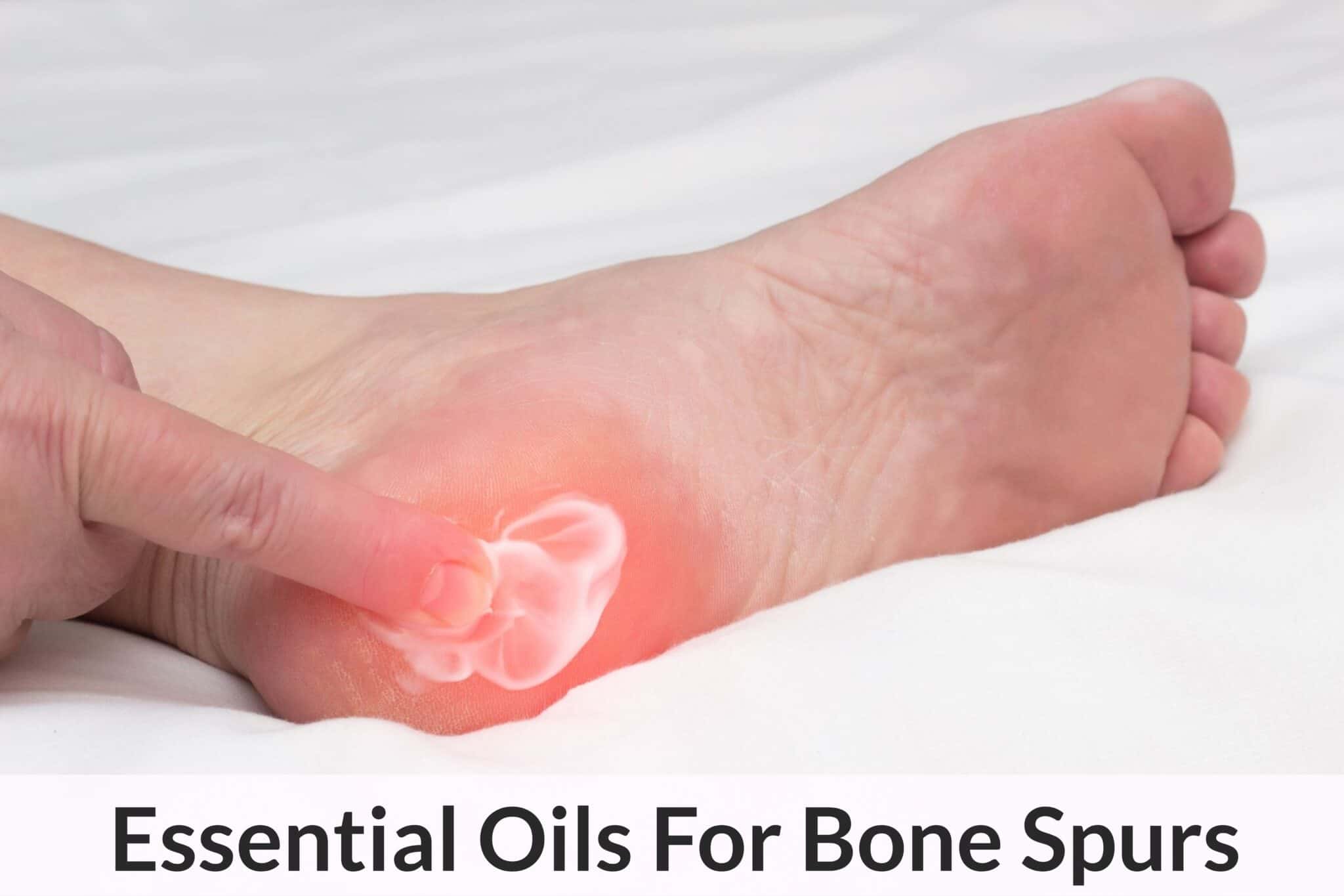 Essential Oils For Bone Spurs When Being Porcupine Boy Doesn’t Sound